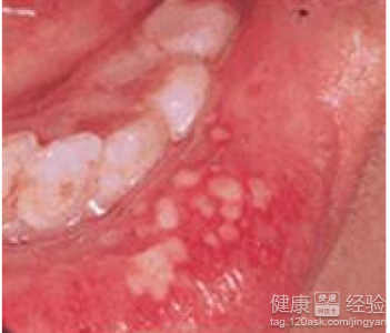 口腔潰瘍的形成原因？