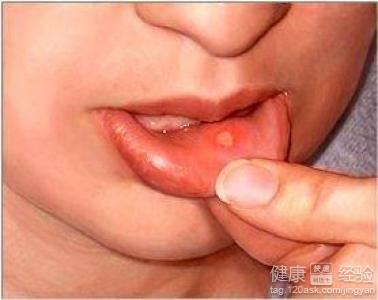 口腔潰瘍該怎麼治愈？