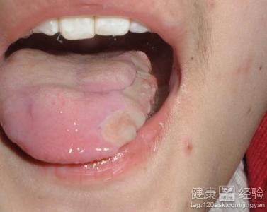 口腔潰瘍有哪些臨床表現呢 ？