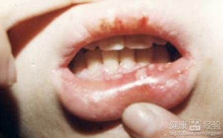 引起口腔潰瘍的原因是什麼