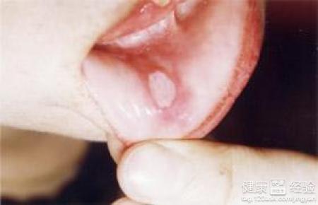 口腔潰瘍是什麼原因？