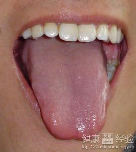 舌尖潰瘍怎麼辦？