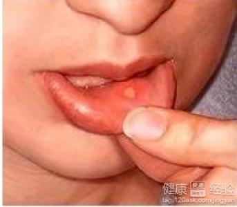 口腔潰瘍的預防方法。