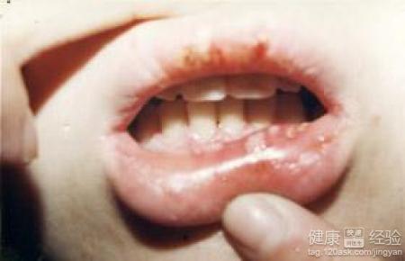 口腔潰瘍的常見治療措施有哪些？
