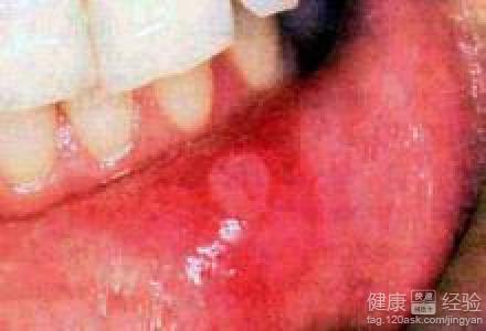 口腔潰瘍是怎麼產生的？