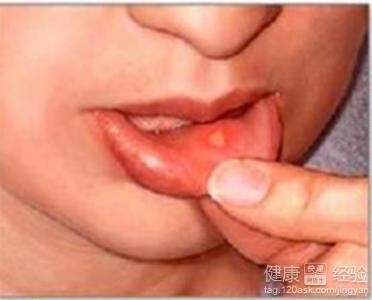 口腔潰瘍患者吃什麼比較好？