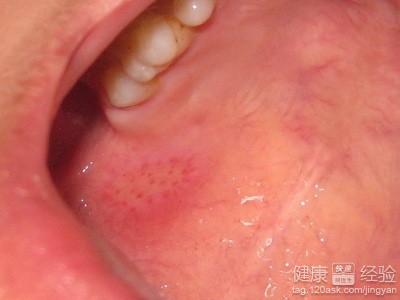口腔潰瘍的預防方法有哪些小竅門。
