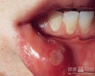 口腔潰瘍不錯的治療方法。