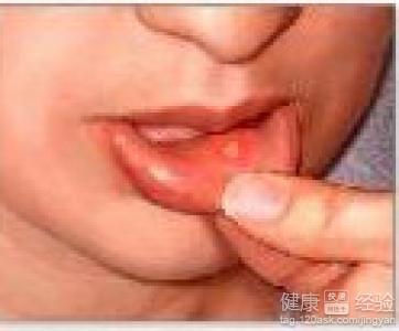 如何預防及處理口腔潰瘍？