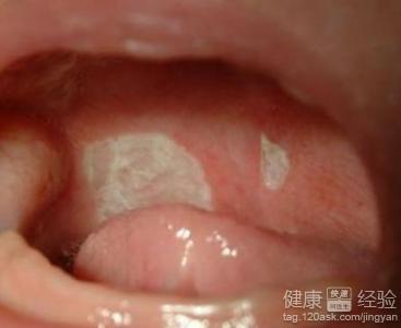 口腔潰瘍能預防嗎