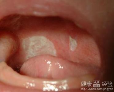口腔潰瘍治療的其它小妙方