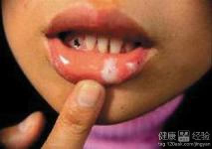 口腔潰瘍怎麼治療呢？