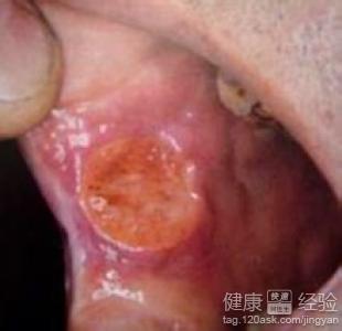 什麼方法能有效治療口腔潰瘍？