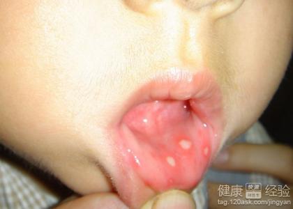 口腔潰瘍應該如何預防