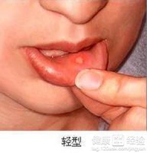 關於口腔潰瘍的治療