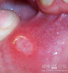 口腔潰瘍應該注意什麼？