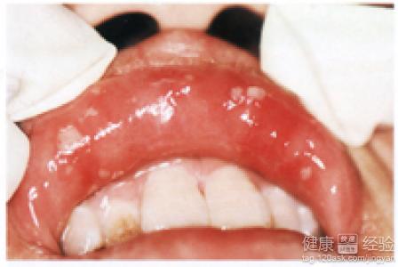 口腔潰瘍怎麼治啊？