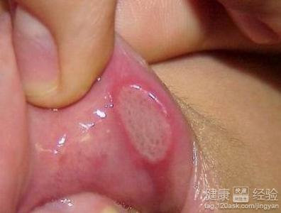 口腔潰瘍的常見治療方法