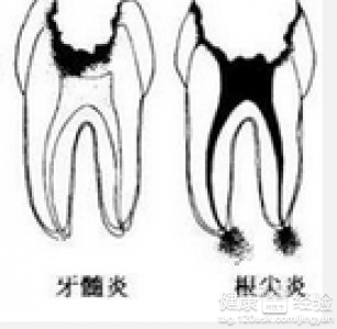 乳牙齲齒的填充治療方法