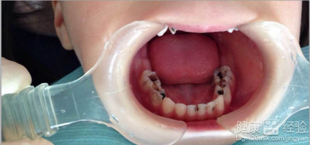 兒童補牙之後還會得齲齒嗎