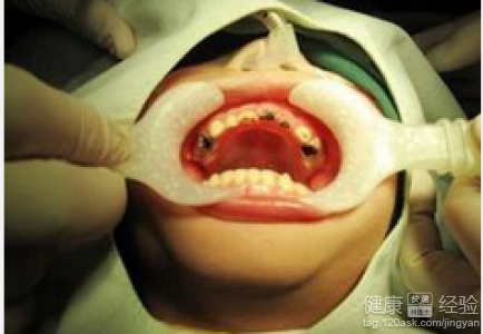 乳牙齲齒會讓寶寶變丑