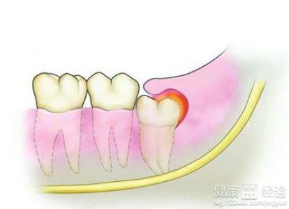 什麼是智齒冠周炎