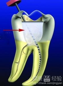 齲齒根管治療好不好