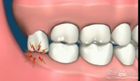 拔智齒一顆多少錢