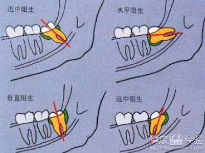 第2步