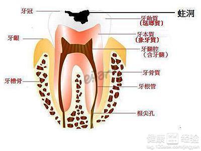 智齒蛀牙一定要拔嗎