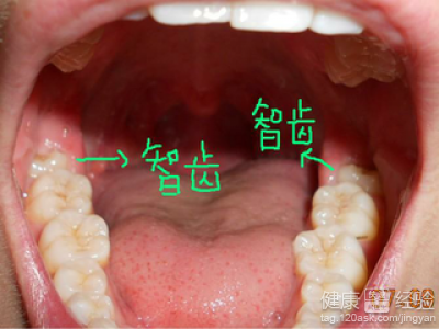 長智齒是什麼原因