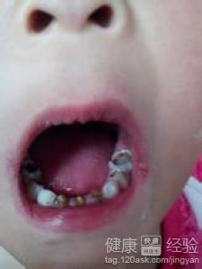 孩子齲齒通過什麼方法可以矯正