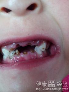 小孩齲齒跟吃糖有關系嗎