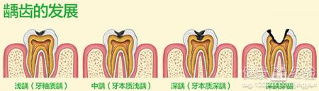 3周歲兒童齲齒，該不該補呢