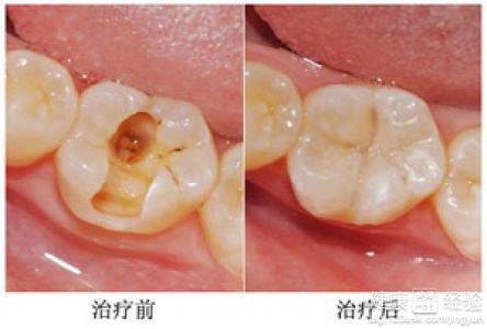 齲齒爛了很多年了，現在能拔嗎