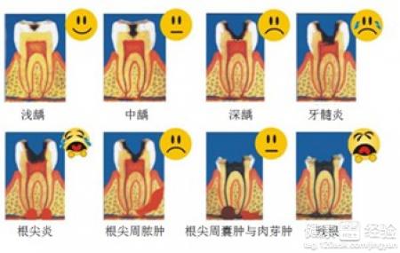 治療齲齒要殺神經嗎