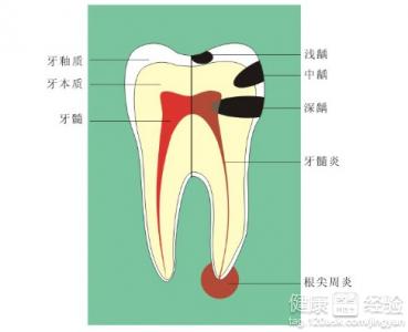 小兒齲齒的預防方法