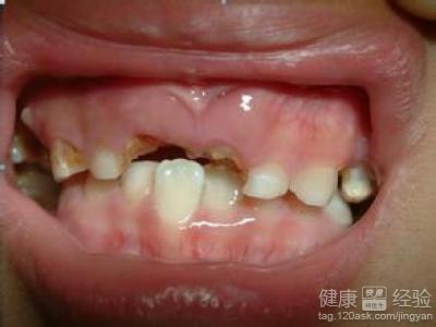 中度齲齒導致牙痛吃什麼藥好