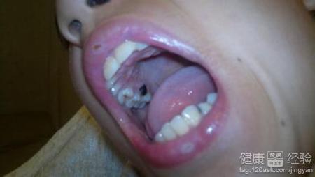 2歲半的小兒檢查出齲齒一顆，該怎麼辦呢
