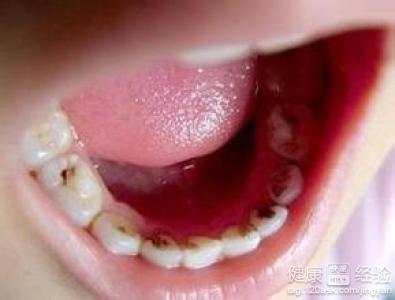 四歲男孩齲齒歷害磨牙也都是洞怎麼辦