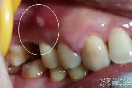 槽牙底下長了個齲齒導致臉腫了，怎麼治療