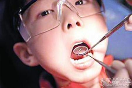 四歲兒童的齲齒不拔牙怎麼治療