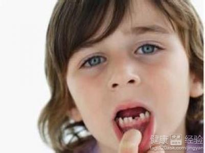 八歲小孩沒換磨牙磨牙齲齒很嚴重怎麼辦