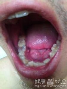 齲齒周圍的牙龈長胞出膿怎麼辦呀
