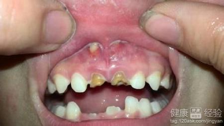 孩子乳牙出現了齲齒怎麼辦