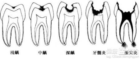 第2步