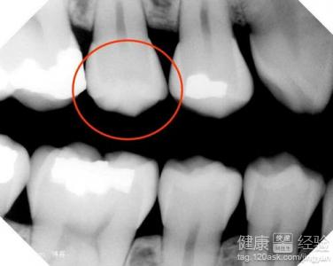 齲齒修復以前堵過怎麼治療