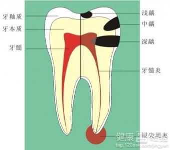 有齲齒了怎麼辦呢