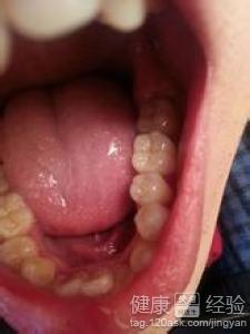 齲齒引起的牙痛怎麼辦