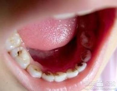 5歲兒童的齲齒能修復嗎